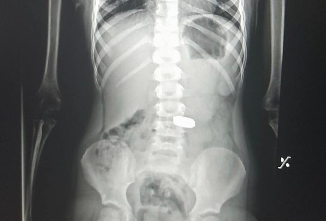 Новини Харкова: Лікарі дістали зі шлунка дитини п'ять монет - фото